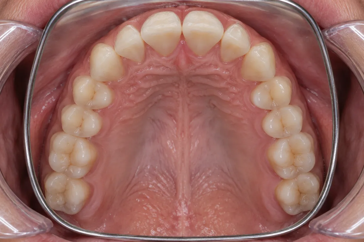 Vue occlusale de l'arcade maxillaire prise au miroir, bord métallique du miroir visible.