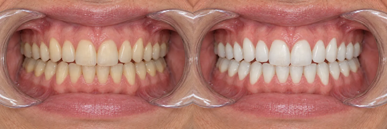 Deux vues de face avec écarteurs au même cadrage : dents plus jaunes avant l'éclaircissement, plus claires après.
