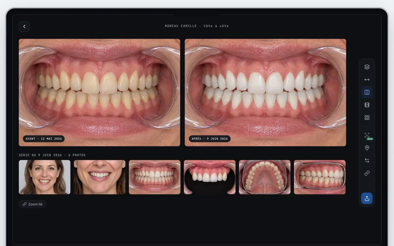 Comparaison côte à côte des dents d'une patiente avant et après éclaircissement dans MedPix, avec la série photo du jour en dessous.