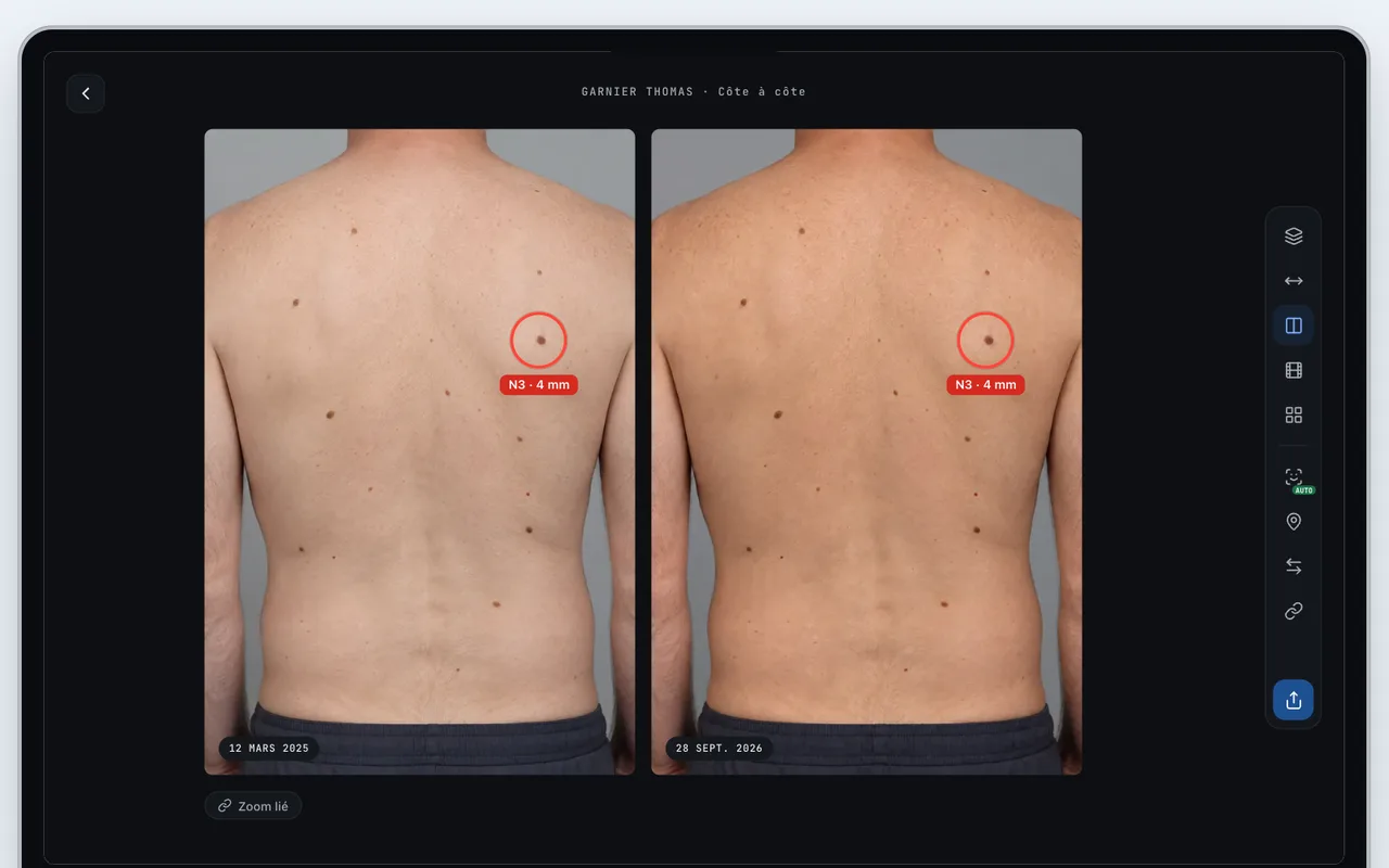 Comparaison côte à côte du même dos à deux dates dans MedPix, avec un nævus entouré et annoté.